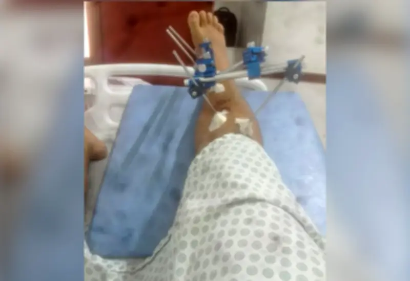 Jovem denuncia agressão policial e bala de borracha em Formoso do Araguaia