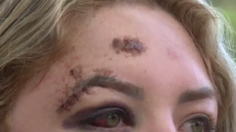 Jovem fratura rosto e tem paralisia facial após ser atropelada por motorista de app em Florianópolis