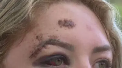 Jovem fratura rosto e tem paralisia facial após ser atropelada por motorista de app em Florianópolis